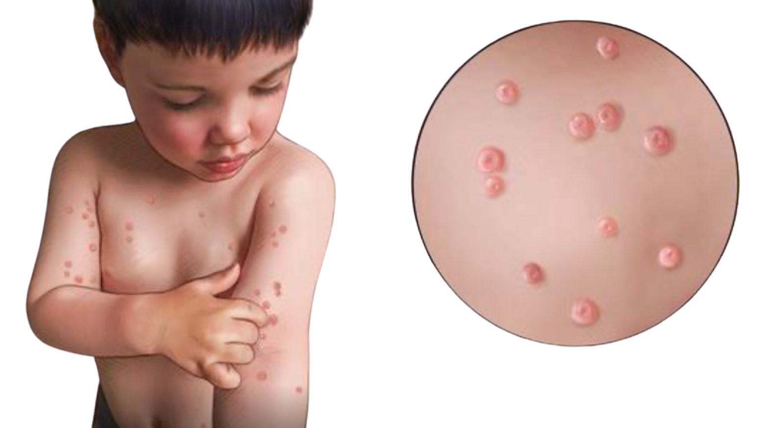 Molluscum Contagiosum Treatment